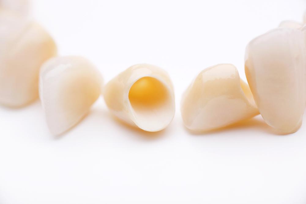 Dental crowns at Ruggless Dental in Springfield IL