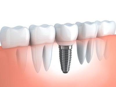 Digital diagram of dental implant in gums with dental crown