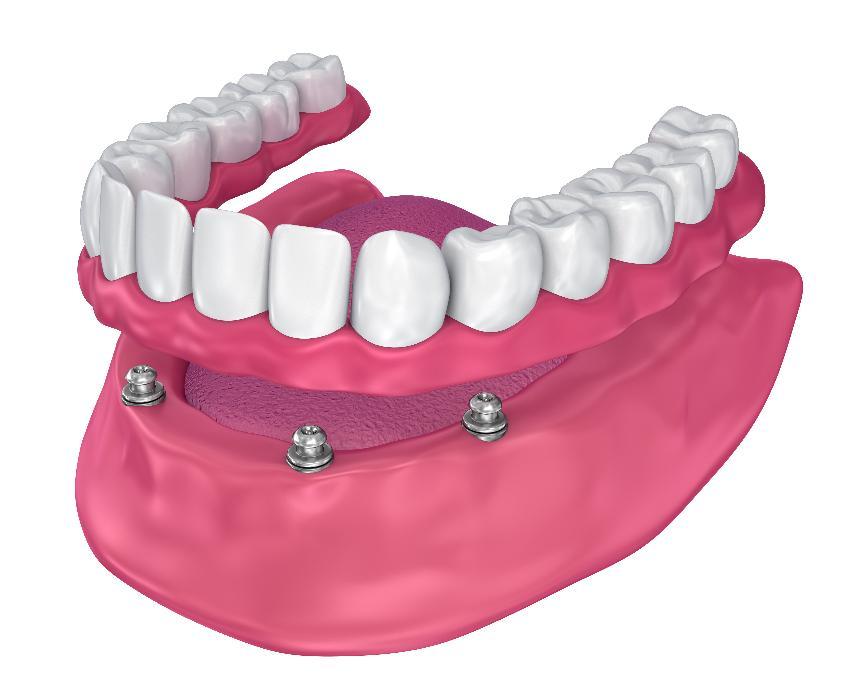 Diagram of implant-supported denture in Springfield IL