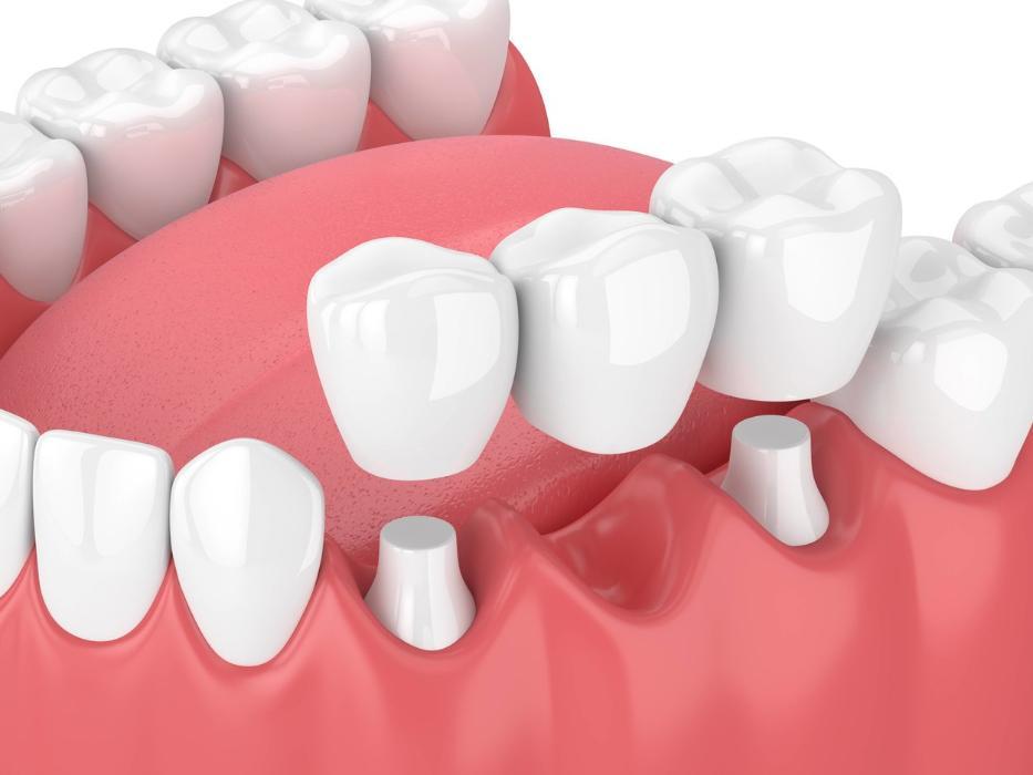 Diagram of a dental bridge replacing teeth in Springfield IL