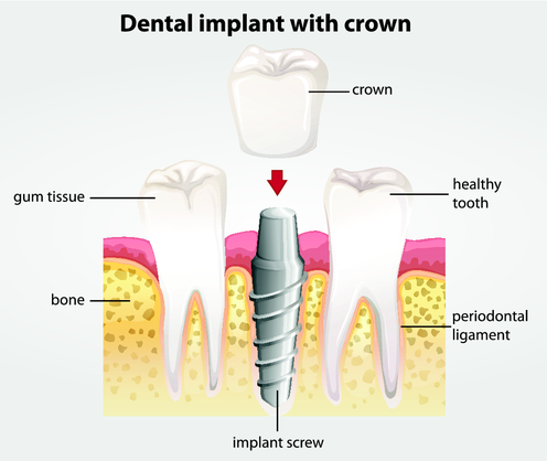 Diagram of dental implant with crown in Springfield IL