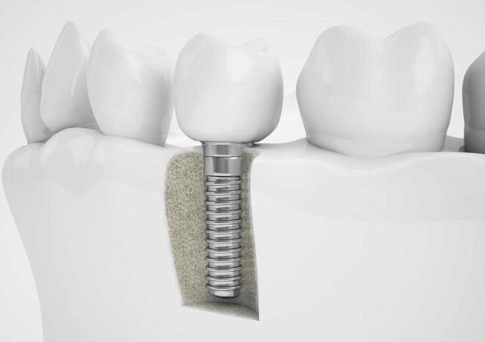 Digital graphic of dental implant screw in gums at Springfield dentist office