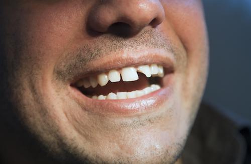 Patient with chipped front tooth at dentist in Springfield