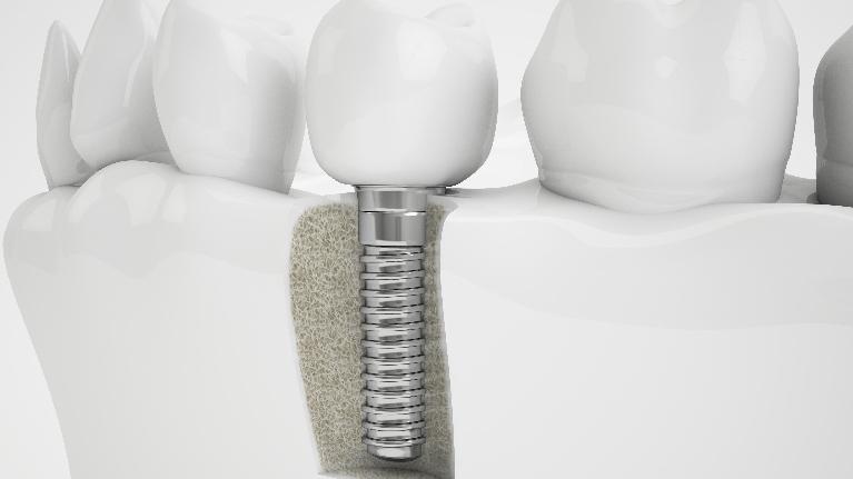 dental implant in bone | dental implants springfield il