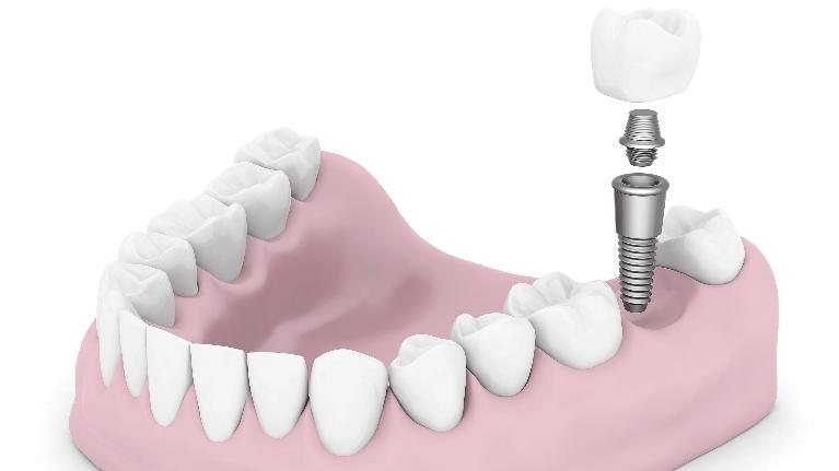 Springfield IL Dental Implants diagram