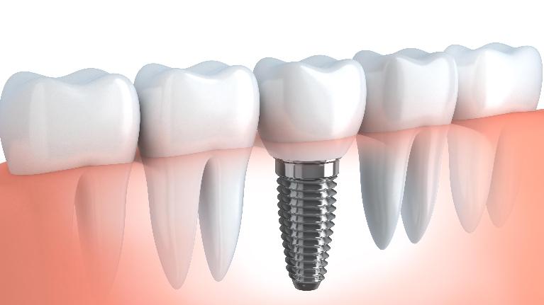 Dental Implants Springfield IL