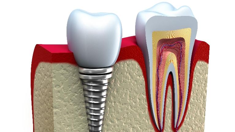 Dental Implants Springfield | Springfield IL Dentist