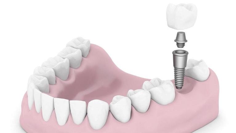 Dental Implants | Dental Blog Springfield IL | Dr. Shane Ruggless