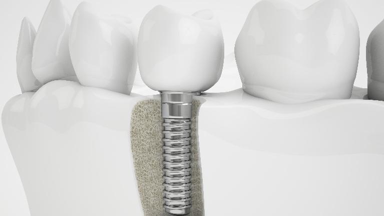 Dental Implant | Ruggless Dental