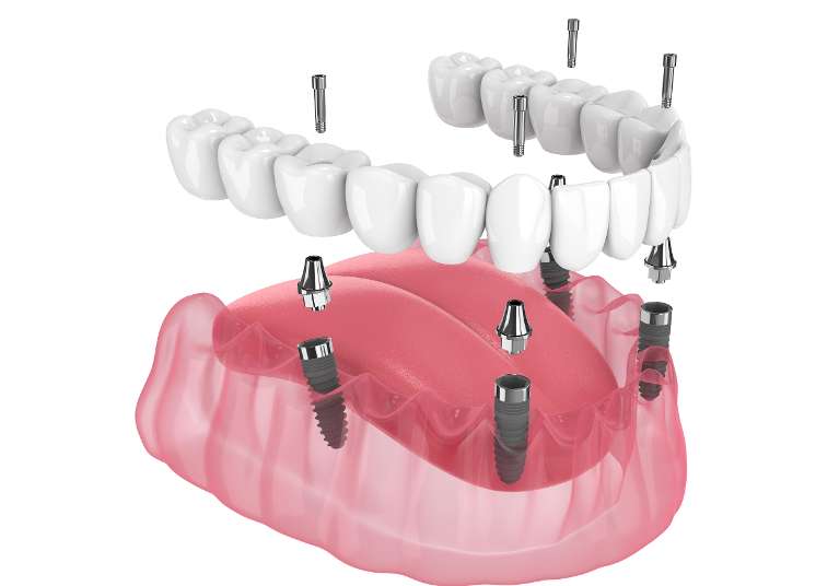 dental implant posts