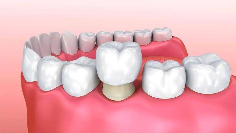 close up of dental crown | dentist springfiled il