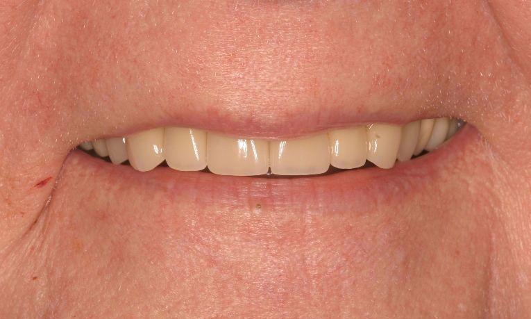 Results from restorative dentistry with dental bridge in Springfield, IL