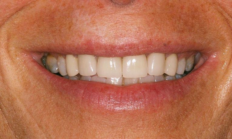 Results from dental crown restoration and professional teeth whitening in Springfield IL