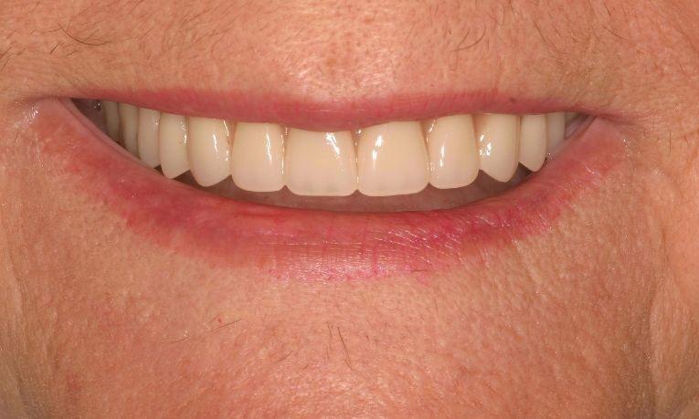 Close up of patients smile with new full dentures from Dr Shane Ruggless