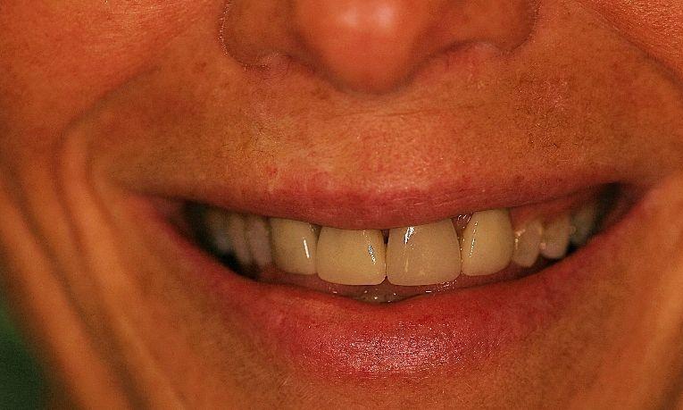 Dental patient with discolored teeth and dental crowns at Ruggless Dental