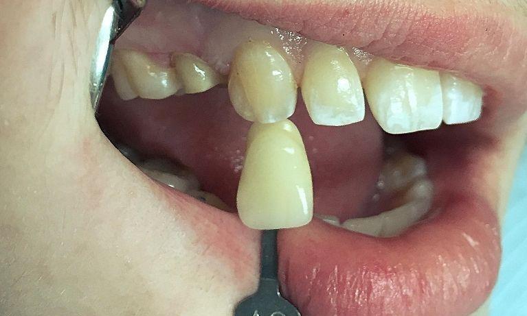 Dental patient with severe cavity and root canal infection at 62704 dental office