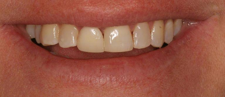 Dental patients teeth with fractured root at 62704 dentist office