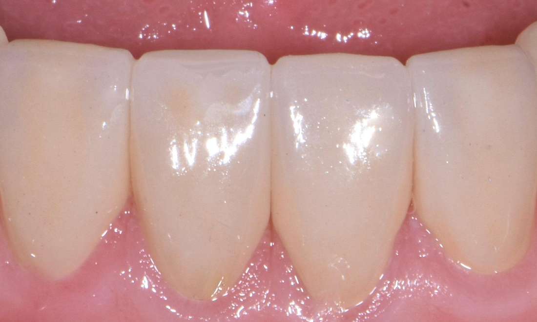 after porcelain crowns