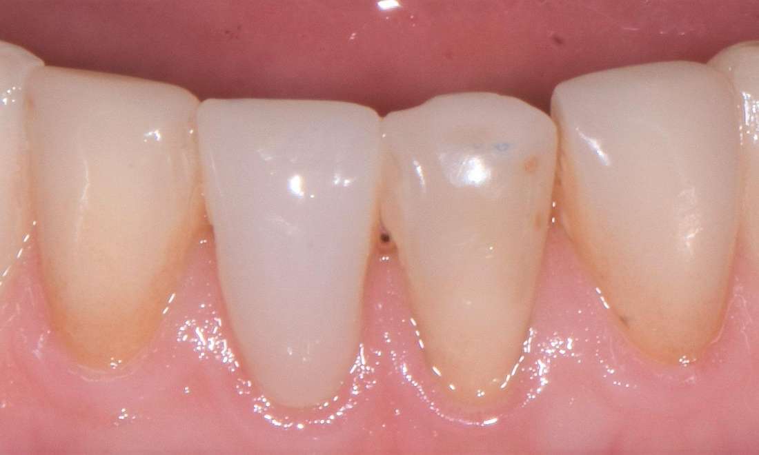 before porcelain crowns