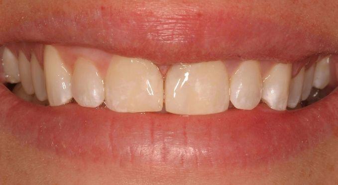 Diastema-Closure-with-Dental-Bonding-After-Image