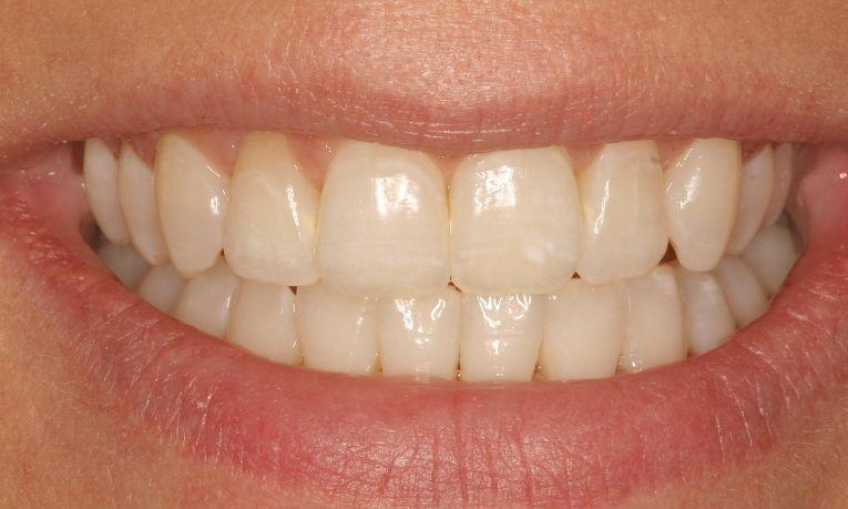 Invisalign-Zoom-Teeth-Whitening-After-Image