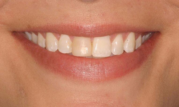 Dental-Veneers-Before-Image