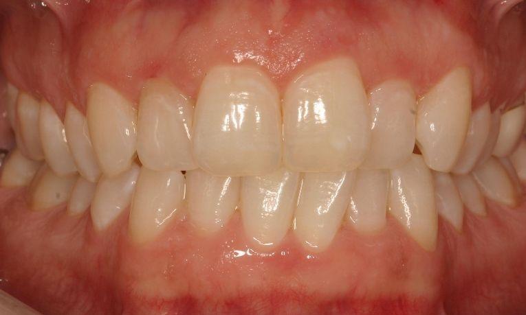 Invisalign-Zoom-Teeth-Whitening-Before-Image