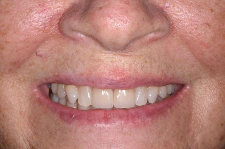 Emergency-Dentistry-Veneers-After-Image