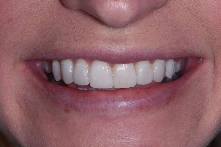 Veneers-After-Image