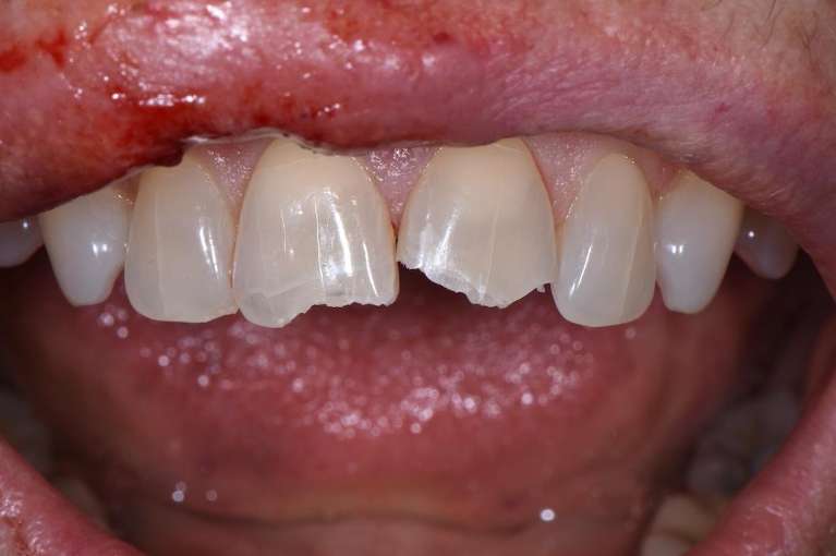 Emergency-Dentistry-Veneers-Before-Image