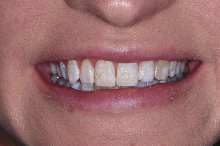 Veneers-Before-Image